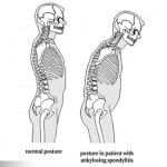 不可忽視的腰酸背痛－ 僵直性脊椎炎