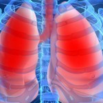 防治肺癌有道　低劑量CT及早揪病灶