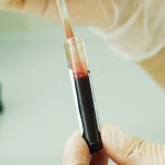 血癌患者對基因療法反應良好