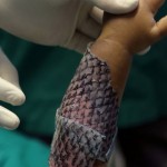 巴西醫生使用魚皮為燒傷患者進行治療
