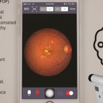 基於智能手機的視網膜成像攜手人工智能，支持對視網膜病變進行高度靈敏的自動化早期檢測