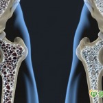 X光驚見骨頭坑坑洞洞　攝護腺癌骨轉移這樣治療可保骨