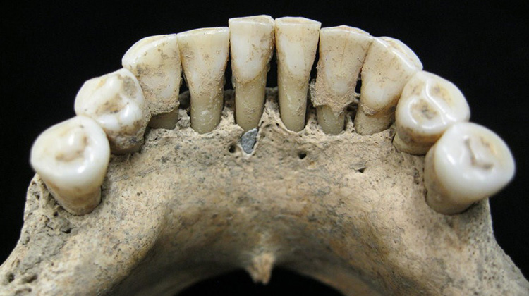 中世紀歐洲婦女的牙齒中發現了青金石