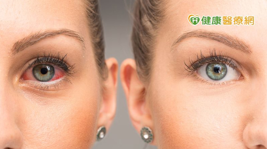 突發性眼睛視線不清　原來是長期淚膜不穩定致乾眼糊矇！