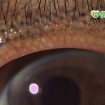 用眼過度也會長蟲蟲？　防疫期眼瞼螨蟲患者增