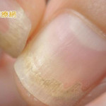指甲變色、變厚、變形不一定是灰指甲！　「這些」都可能產生指甲症狀
