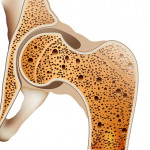 AI精準預測結合骨質整合照護，顧骨本、不骨折有期待