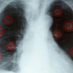 肺腺癌是奪命癌，不抽菸女性更需大力關注