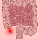 急性闌尾炎輕忽不得