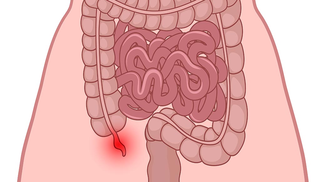 急性闌尾炎輕忽不得