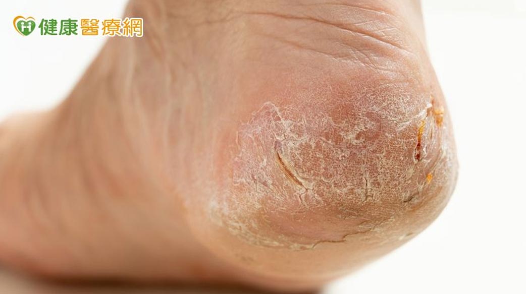 冬天皮膚乾裂不只是缺水？中醫解析4種體質與日常改善關鍵