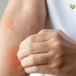 乾癢脫屑反覆發作　可能不只是氣候乾燥！中醫談常見類型與日常保養