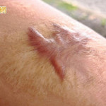 每天睡不到兩小時！中年女罹「蟹足腫」困擾30年　跨科聯手救回她的睡眠