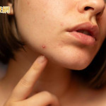 不只青春期！醫：痘痘也困擾上班族、更年期婦女　研究揭僅3成就醫