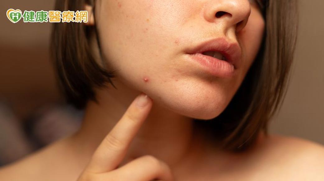不只青春期！醫：痘痘也困擾上班族、更年期婦女　研究揭僅3成就醫