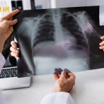 破解肺癌偽裝身份！靠免疫四藥聯合有望取得長期存活效益
