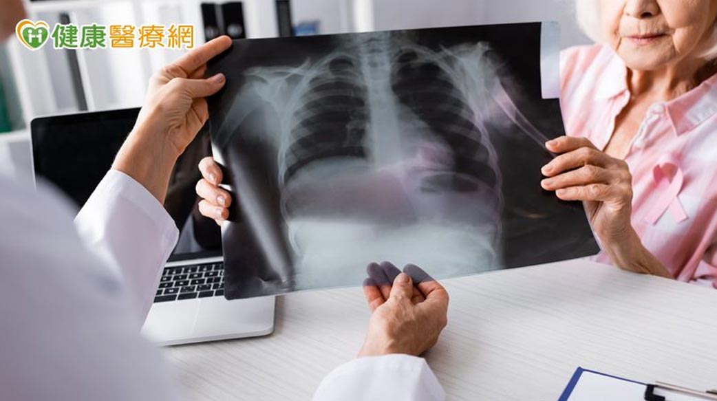 破解肺癌偽裝身份！靠免疫四藥聯合有望取得長期存活效益