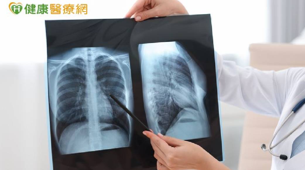 晚期肺癌治療進入組合療法時代　醫：第一線治療策略攸關後續布局