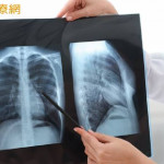 晚期肺癌治療進入組合療法時代　醫：第一線治療策略攸關後續布局