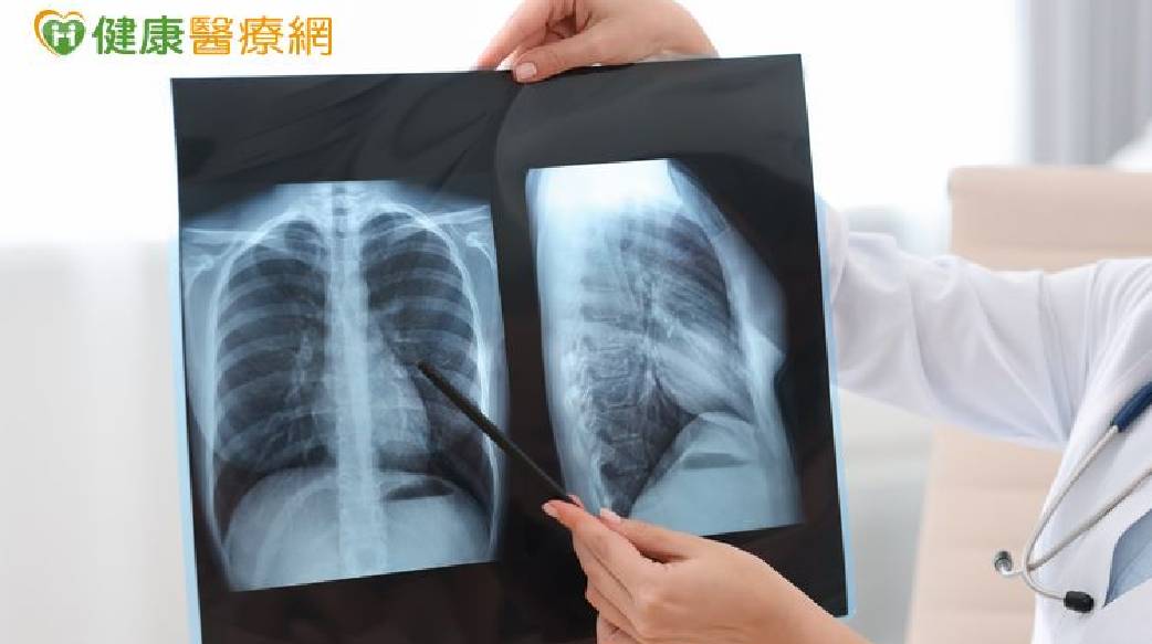 晚期肺癌治療進入組合療法時代　醫：第一線治療策略攸關後續布局