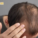 37歲男頭髮愈來愈少以為雄性禿！抽血揪「真正原因」　竟是缺這營養素