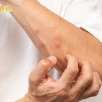 換季皮膚乾癢怎麼辦？醫揭常見原因　保濕、洗澡習慣是關鍵